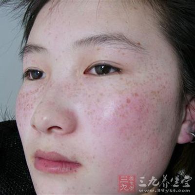 脸上长黄褐斑怎么调理?-脸上长雀斑怎么调理