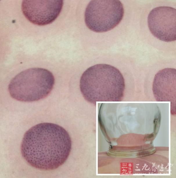 不能选择不正确的位置拔罐,出血量也不能太多,去拔罐的人一般后背都会