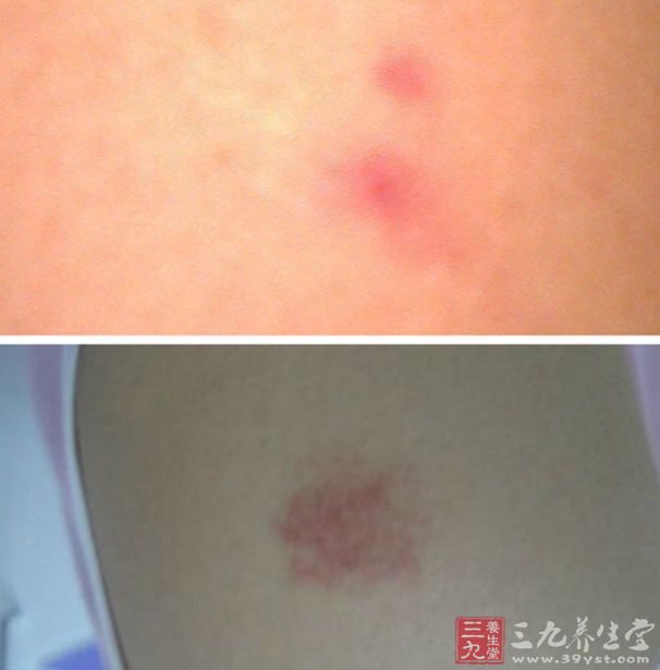 如何缓解风湿性心脏病(2)