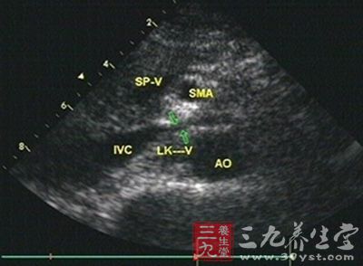 经过行尿红细胞形态检查发现并非肾小球性肾炎,腹部b超提示胡桃夹现象