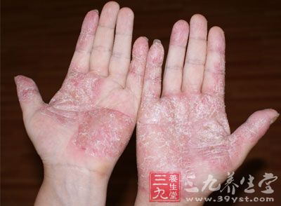 脾虚湿蕴或血虚风燥导致皮肤失养,化燥生风而引起,并不一定是血热