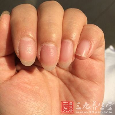 指甲上有横纹 指甲揭露你的健康状况(5)
