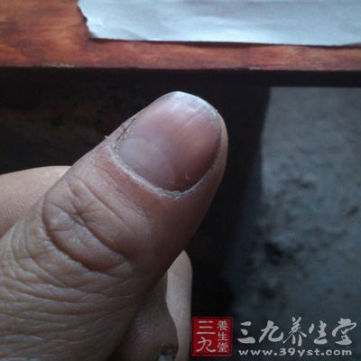 指甲上有横纹 指甲揭露你的健康状况(4)