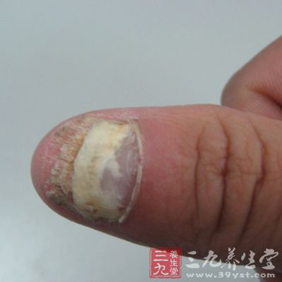 灰指甲的治疗土方法 6个土方法治疗灰指甲(3)