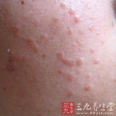 苦情痣一般长在脖子后面的正中央部位 苦情痣一般长在脖子后面的正中央部位