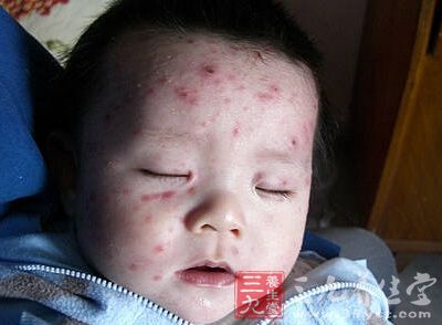 今年冬季水痘发病比往年明显增加