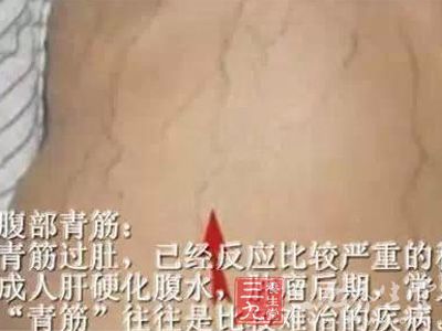 2,小腿有青筋静脉曲张严重者往往发生腰腿疾病,风湿关节痛.