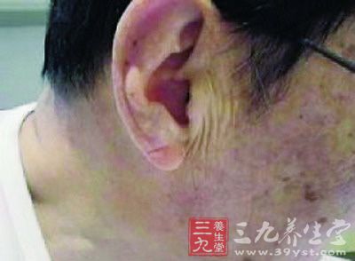 耳垂长皱纹也许会威胁心血管