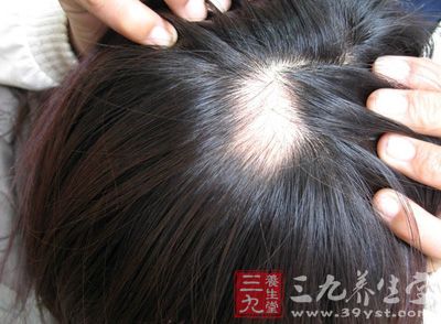 研究人员找到<em>头发再生</em>新<em>方法</em>