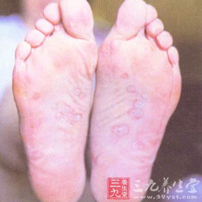 新梅毒免疫检测促进临床诊疗