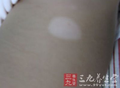 白癜风其实是不会传染的 白癜风其实是不会传染的