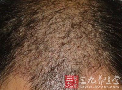 控制油脂分泌的关键是要尽量减少油脂的摄入