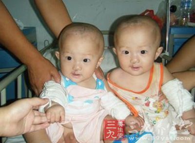 双胞胎宝宝唇腭裂 不及时治疗或致命