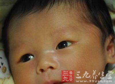新生儿黄疸怎么回事 新生儿黄疸如何治疗