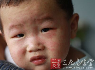 北京麻疹高发 1月份成人儿童病例各占半数