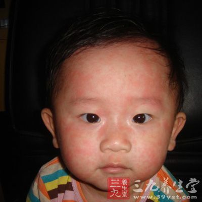 北京暴发麻疹疫情 接种疫苗为预防关键