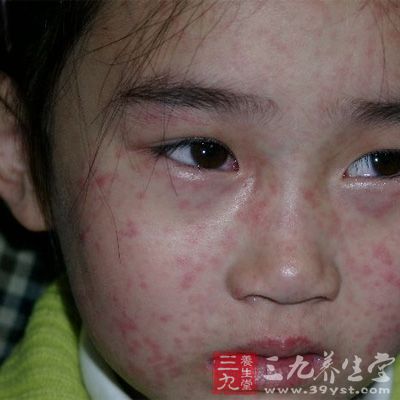 京疾控中心回应北京某大厦一半人得麻疹
