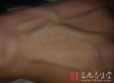 手背有青筋提示腰背部有积滞容易导致腰积劳损