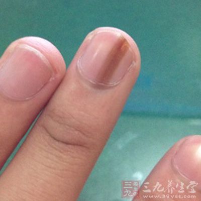 指甲上有白点是怎么回事 手指盖上的疾病(2)