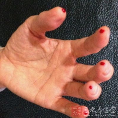 十宣穴位于十个手指尖端的正中，左右手共十个