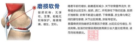 磨损软骨 磨损软骨