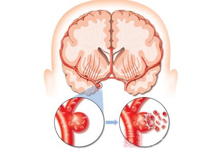 脑卒中患者病情稳定后72小时,就可以尽早开始康复治疗 脑卒中患者病情稳定后72小时,就可以尽早开始康复治疗