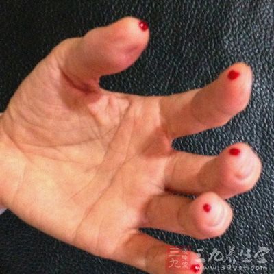 高热时,用三棱针点刺放血,出血3—5滴为宜 高热时,用三棱针点刺放血,出血3—5滴为宜