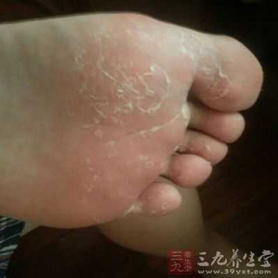 治足癣前先控 治足癣前先控