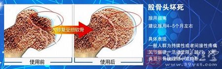 股骨头坏死 股骨头坏死