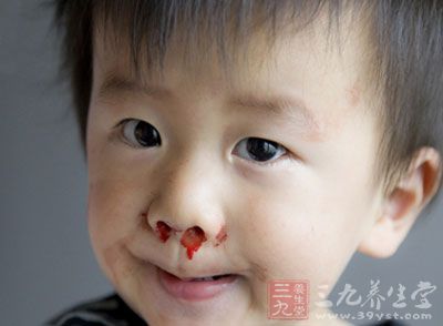 流鼻血怎么办 流鼻血怎么快速止血