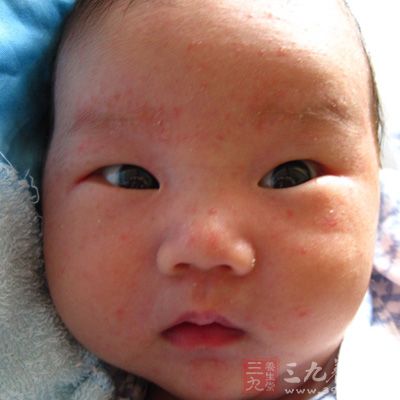 宝宝脸上长湿疹怎么办 怎样吃好得快(4)