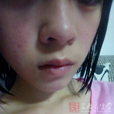 脸部过敏发红怎么办 教你有效缓解脸部过敏