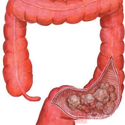 研究发现结直肠癌发病率或随年龄增长而增加