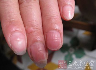 指甲凹陷 指甲凹陷如何预防