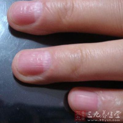 指甲凹陷 指甲凹陷如何预防