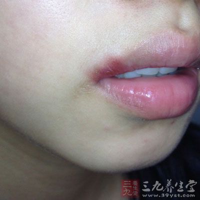 唇炎是一种以口唇干燥,皲裂,脱屑为主要临床表现的粘膜病