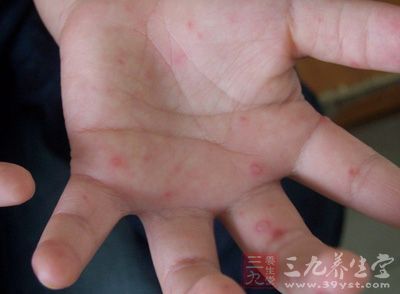 手足口病进入高发期 警惕孩子手脚有无疱疹