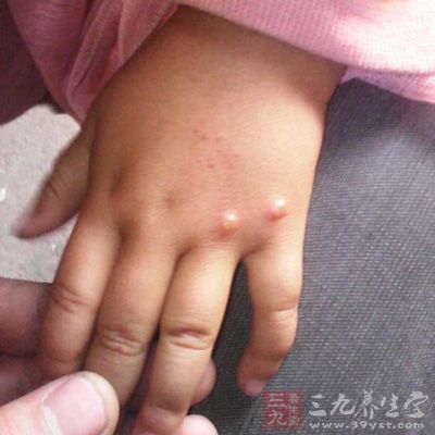 学龄前儿童是水痘的高发人群,如果小孩感染了带状疱疹症状就是出水痘