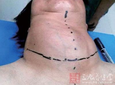 脖子长肿块40年一直没在意 原是甲状腺肿瘤