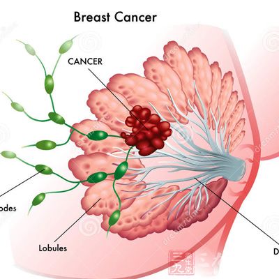 乳腺癌早期症状(5)