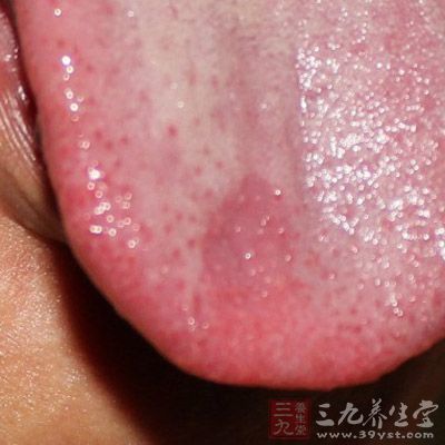 舌头溃疡 (2)