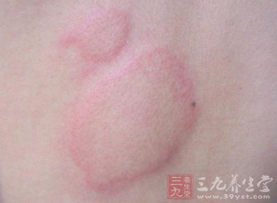 春季皮肤病高发 应及时就诊