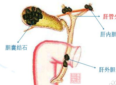 胆囊结石的形成,在我们饮食的不规律导致肝细胞合成的胆汁中胆固醇