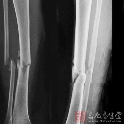JCO造血干细胞移植增加骨折发生率