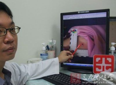 腋窝鼓起许多小疙瘩 竟是淋巴瘤