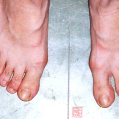 孕妇脚底板疼_脚底板疼是怎么回事