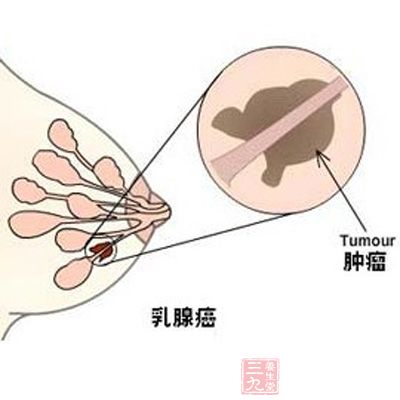 乳腺癌成女性第一杀手 三早提高治愈率