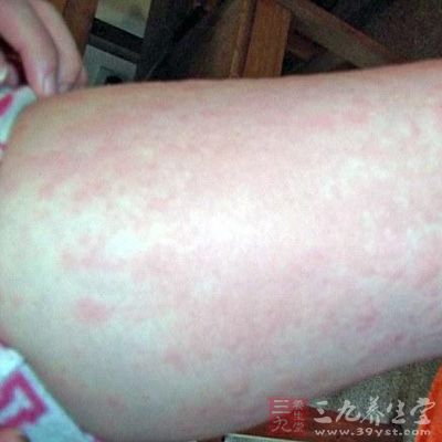 过敏体质者要和虾保持距离