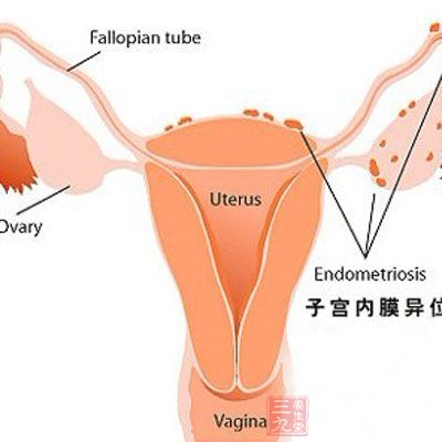 先兆流产和宫外孕的女性，怀孕初期也会出现阴道出血的症状，这也很容易被人误以为是正常的月经