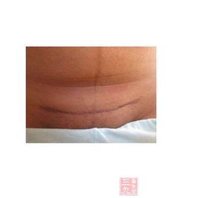 剖腹产疤痕也可表现为发红、发痒、凸起，和疤痕疙瘩类似